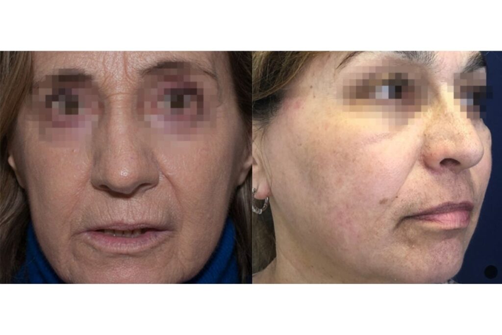 Láser Pixel CO₂ facial para rejuvenecimiento, cicatrices y renovación de la piel